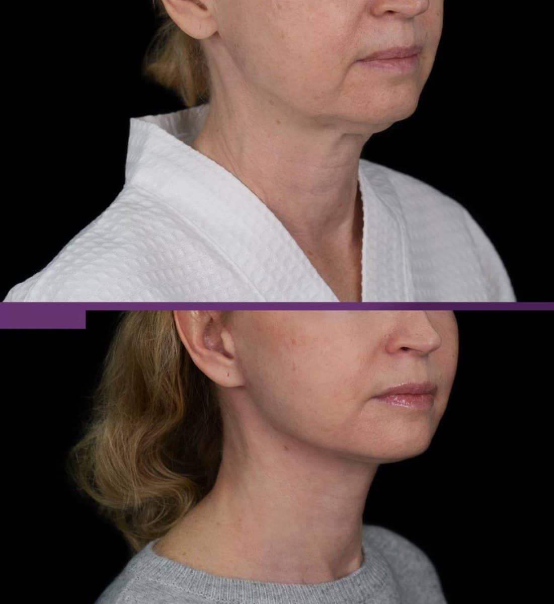 Case 20367 - chin implant