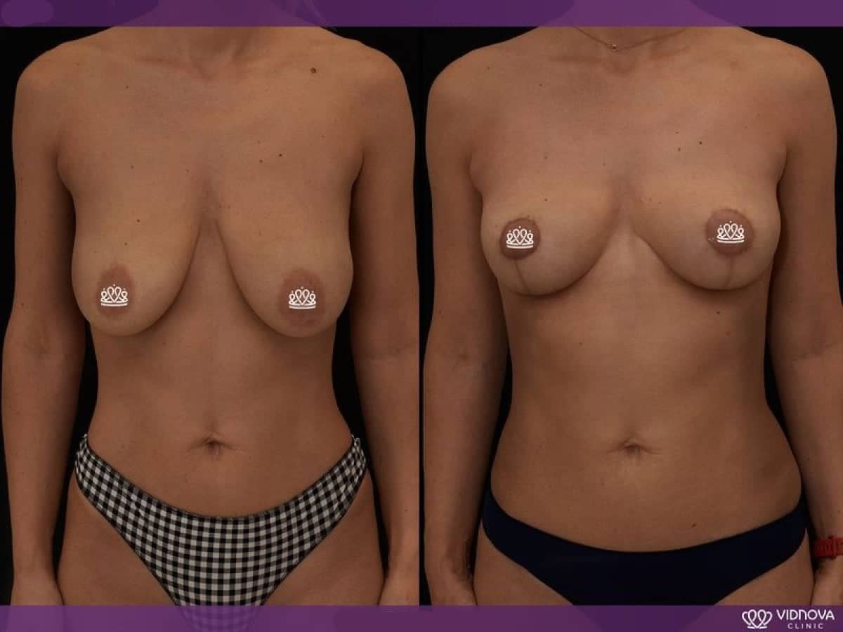 Case 20368 - breast lift
