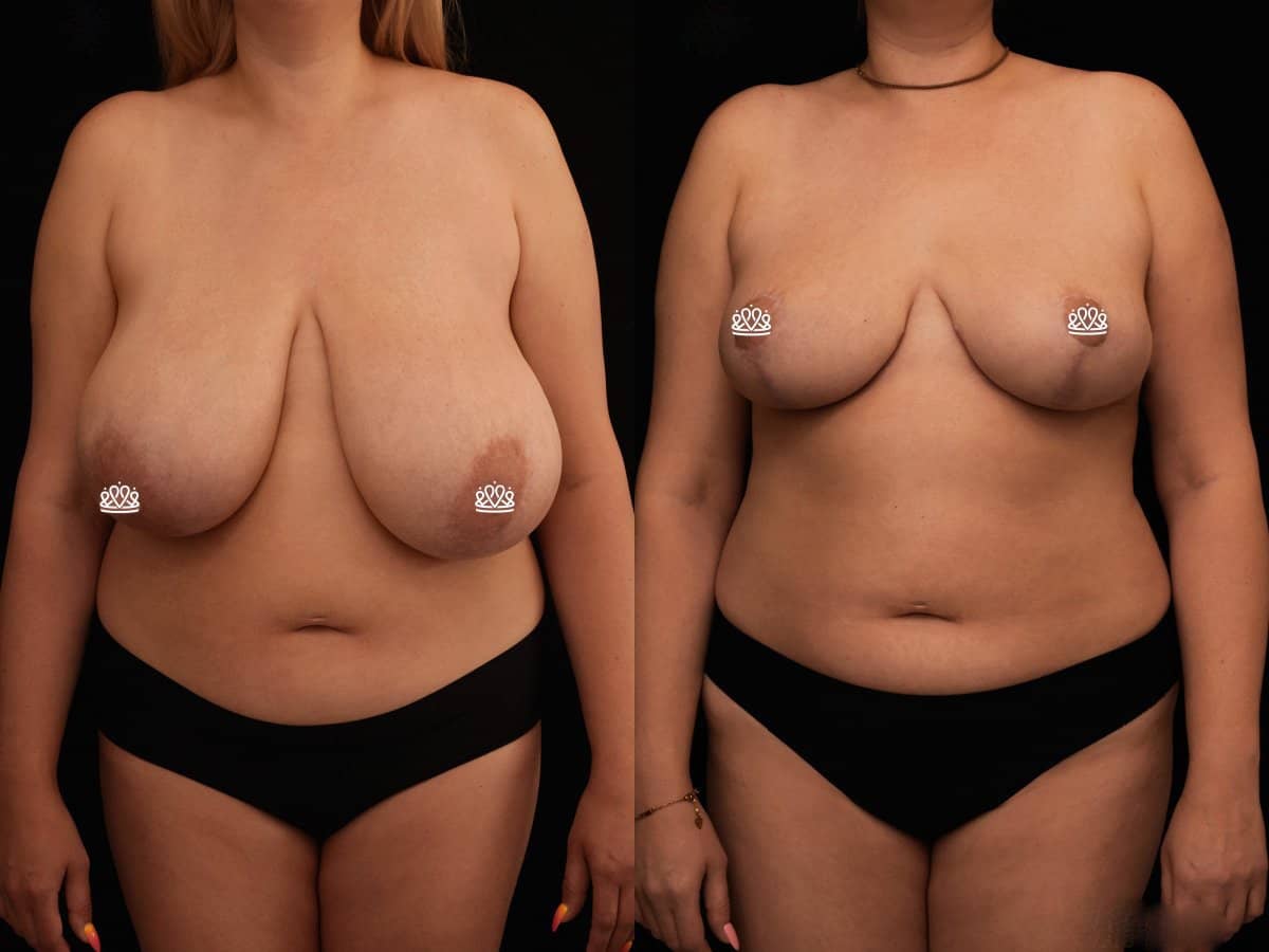 Case 20371 - breast reduction
