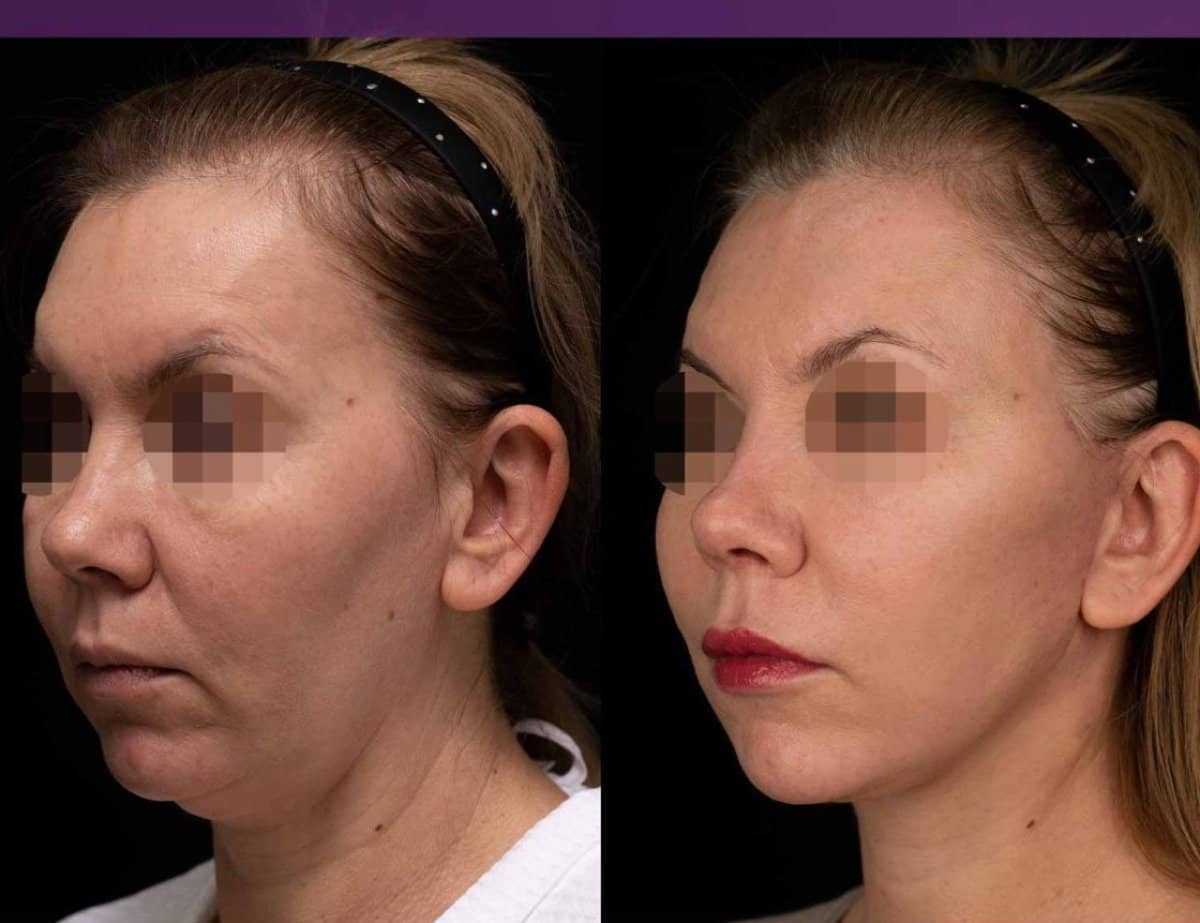 Case 20375 - endoscopic facelift