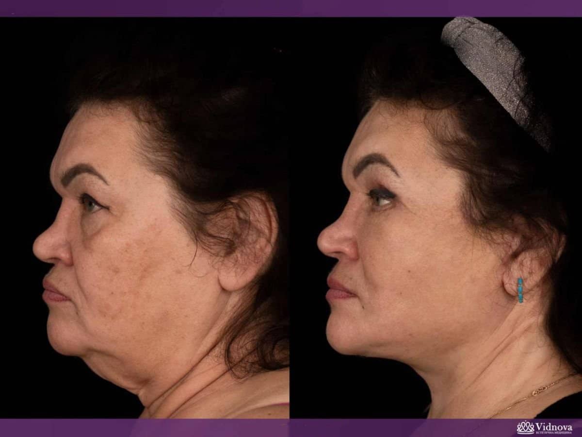 Case 20376 - neck lift