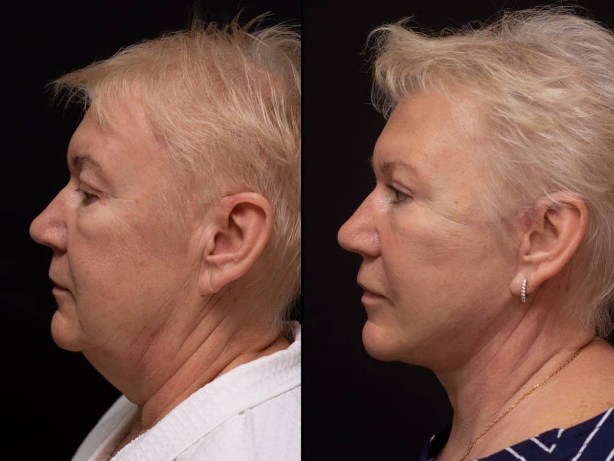 Case 20378 - neck lift
