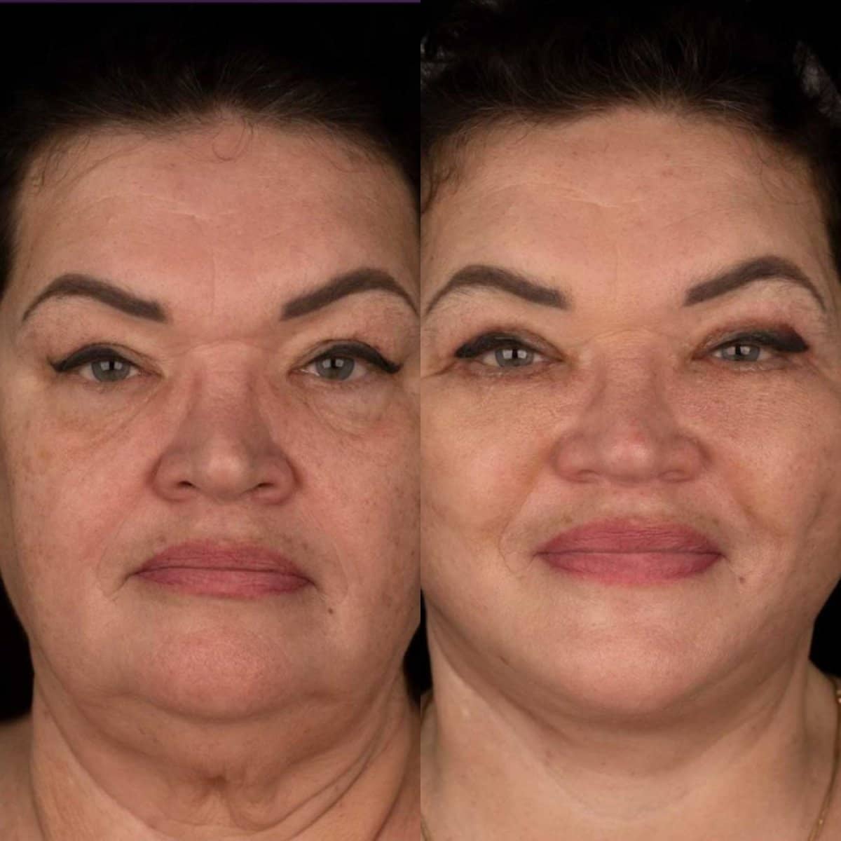 Case 20382 - brow lift