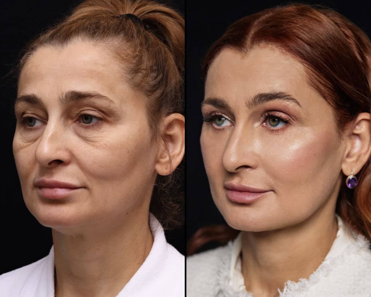Case 20383 - facelift