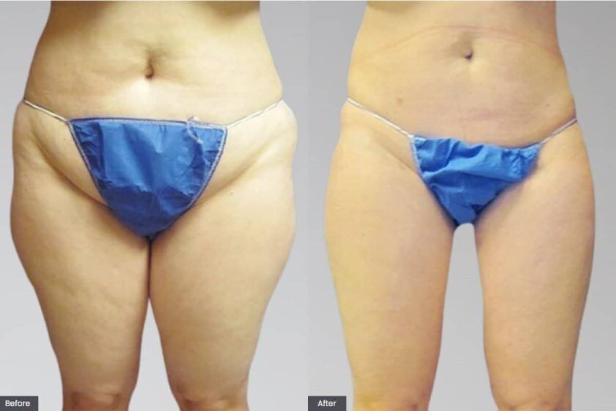 Case 20389 - thigh lift