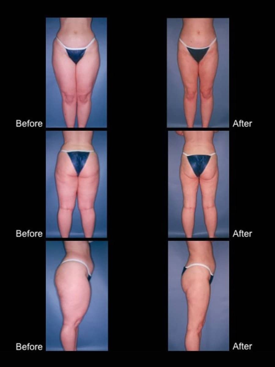Case 20390 - thigh lift
