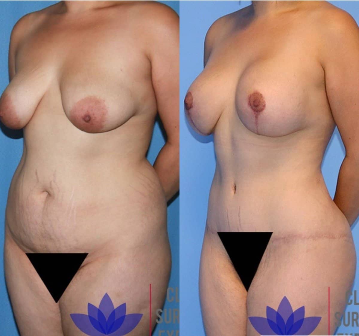 Case 20391 - breast lift and tummy tuck
