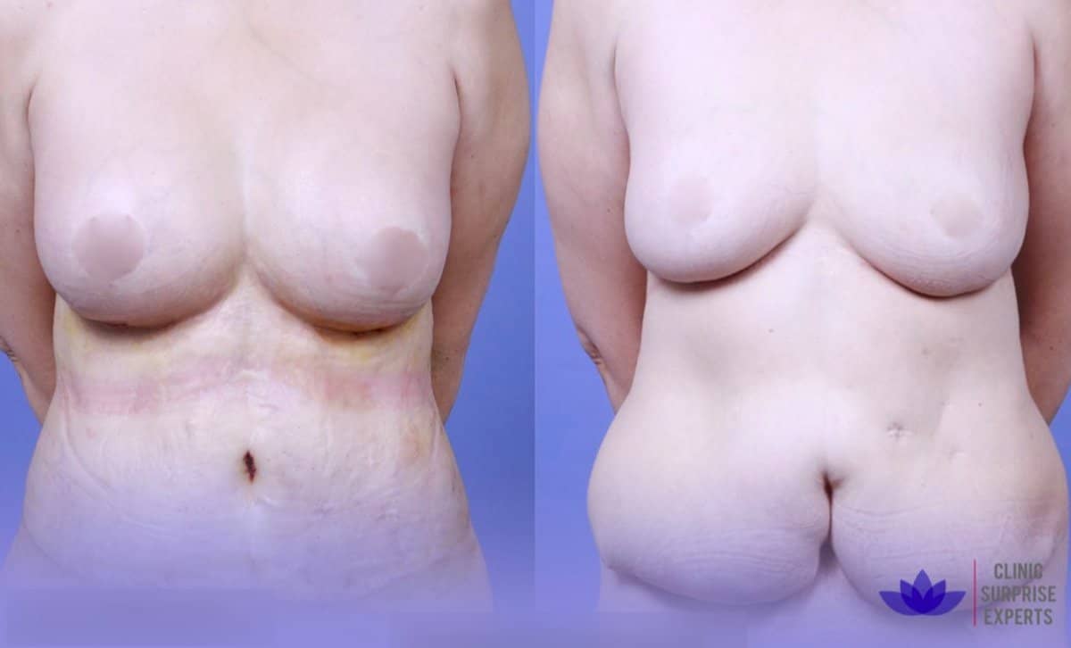 Case 20392 - tummy tuck