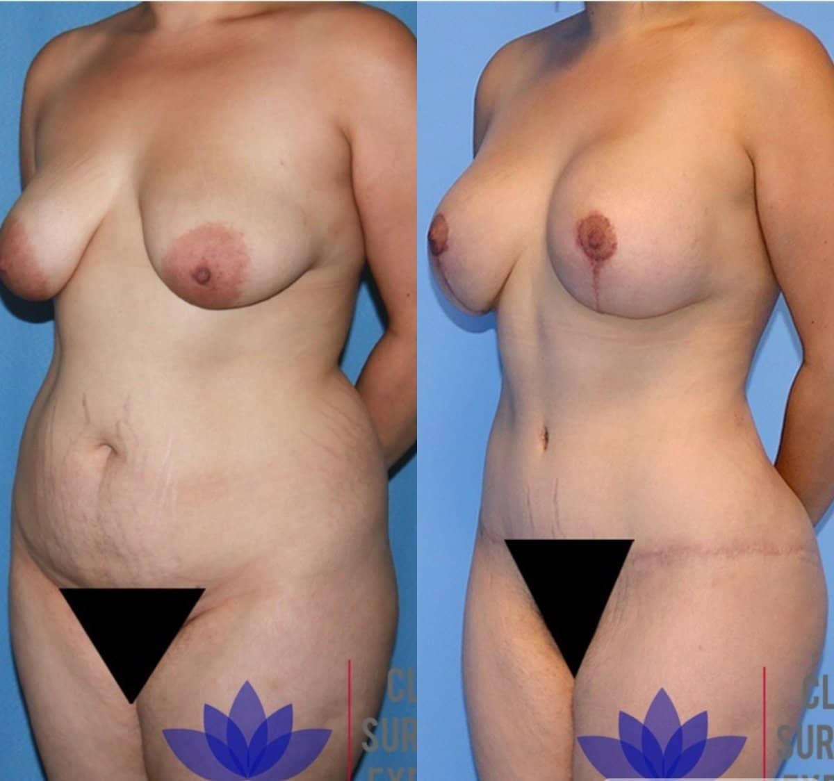 Case 20396 - breast reduction and tummy tuck