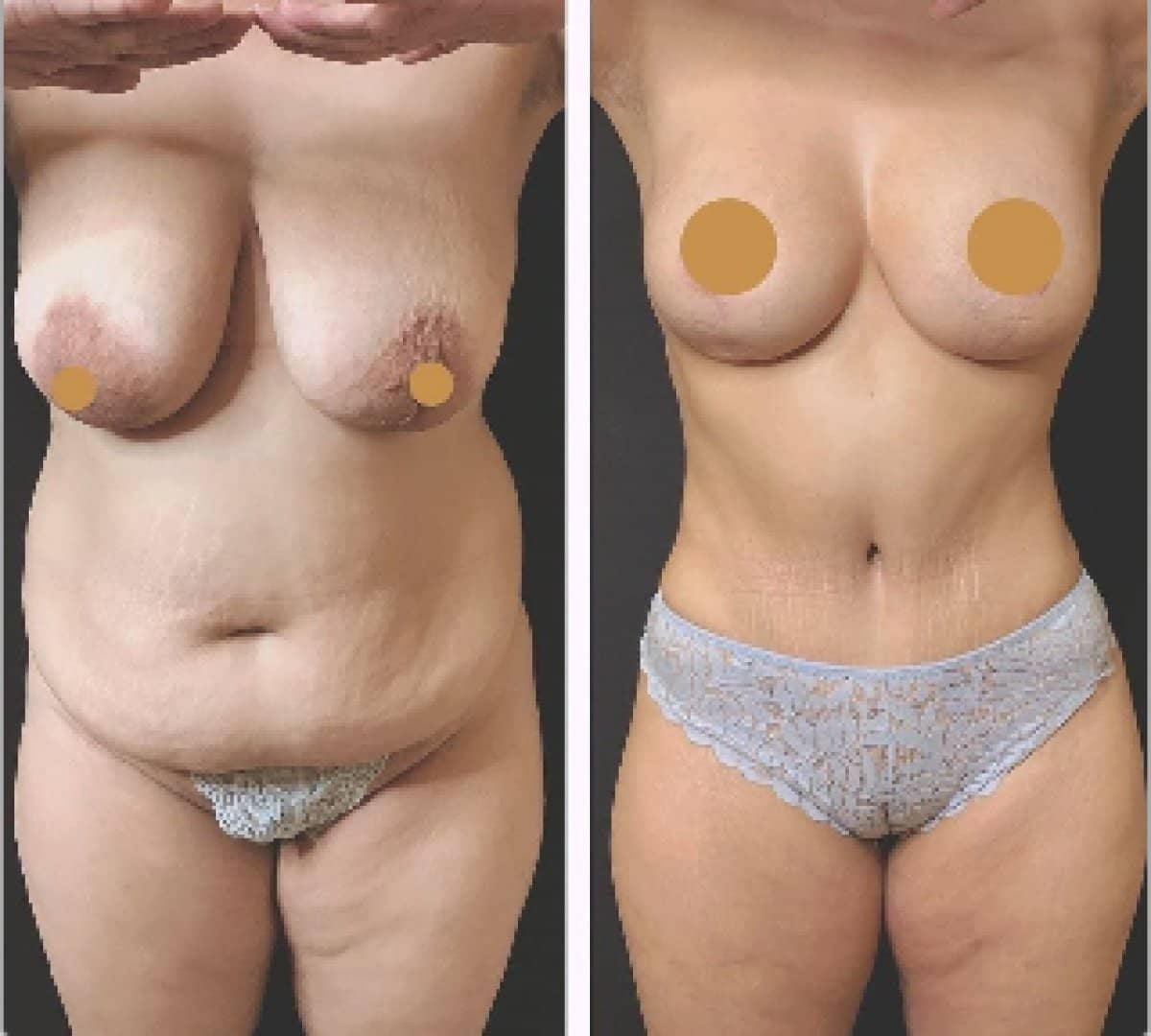 Case 20397 - breast lift
