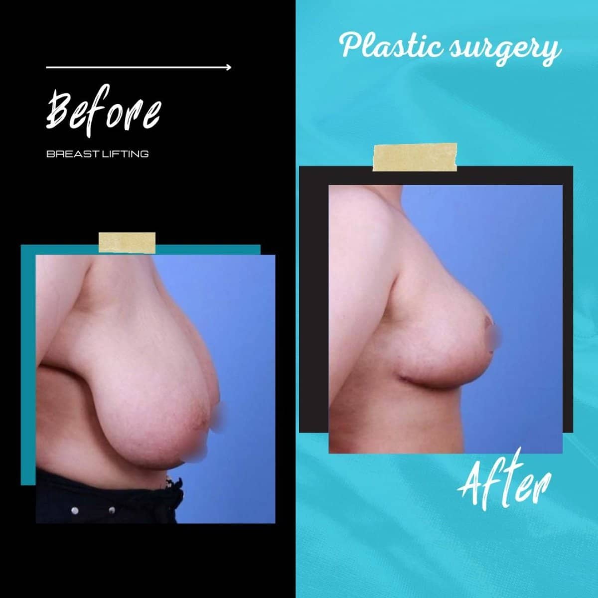Case 20398 - breast lift