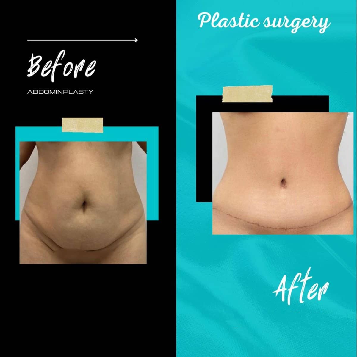 Case 20400 - abdominoplasty