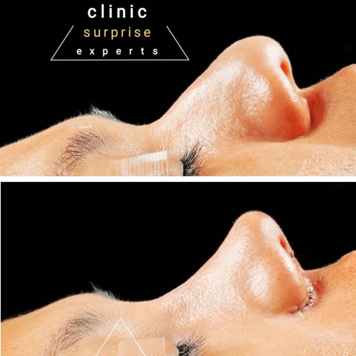 Case 20401 - rhinoplasty