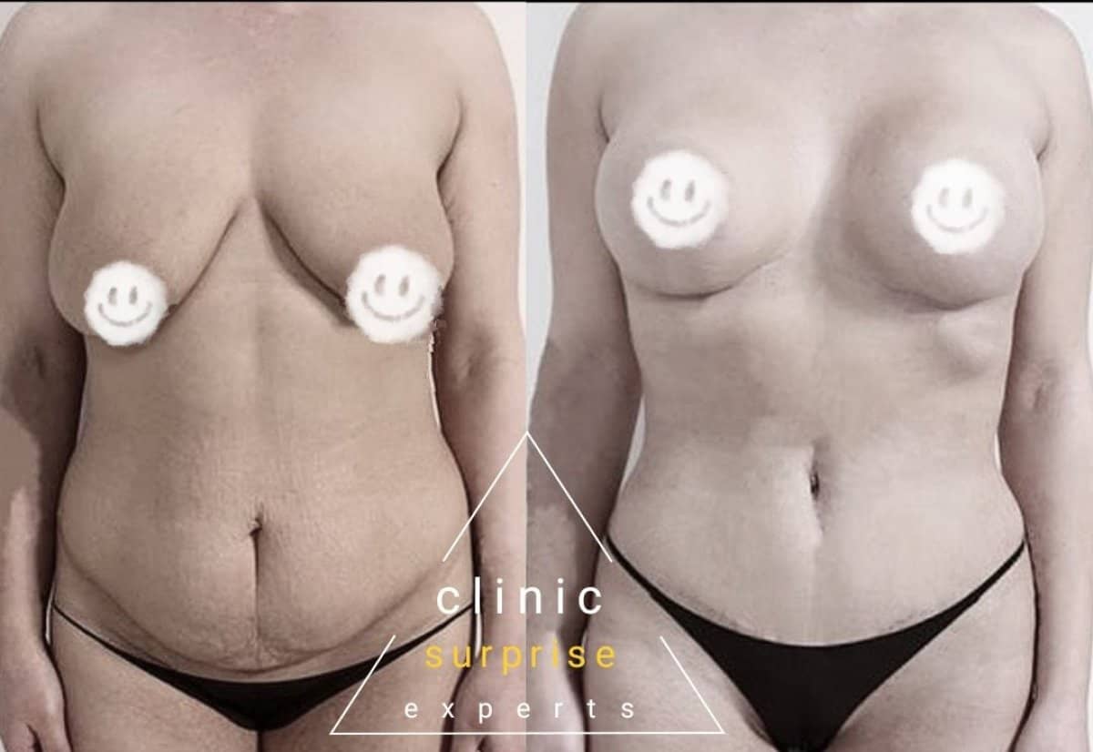 Case 20402 - mommy makeover