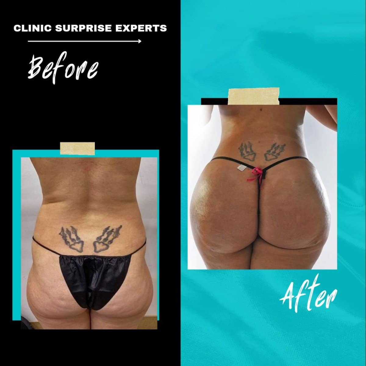 Case 20403 - Brazilian Butt Lift