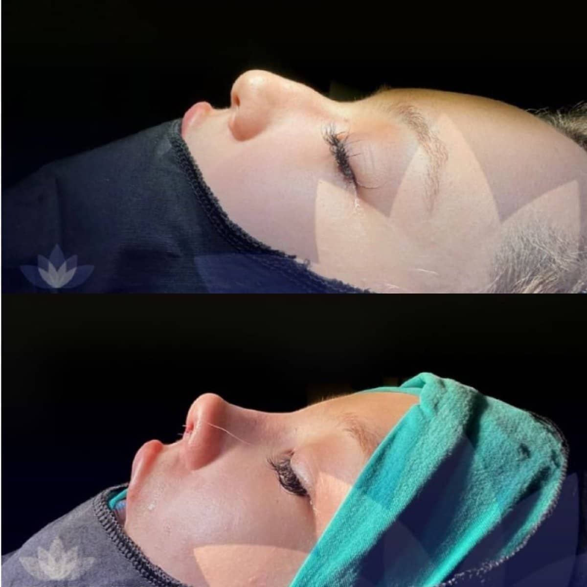 Case 20404 - rhinoplasty