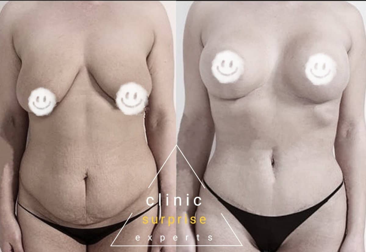 Case 20405 - breast lift