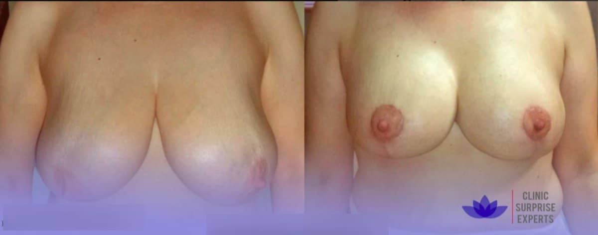 Case 20407 - breast lift
