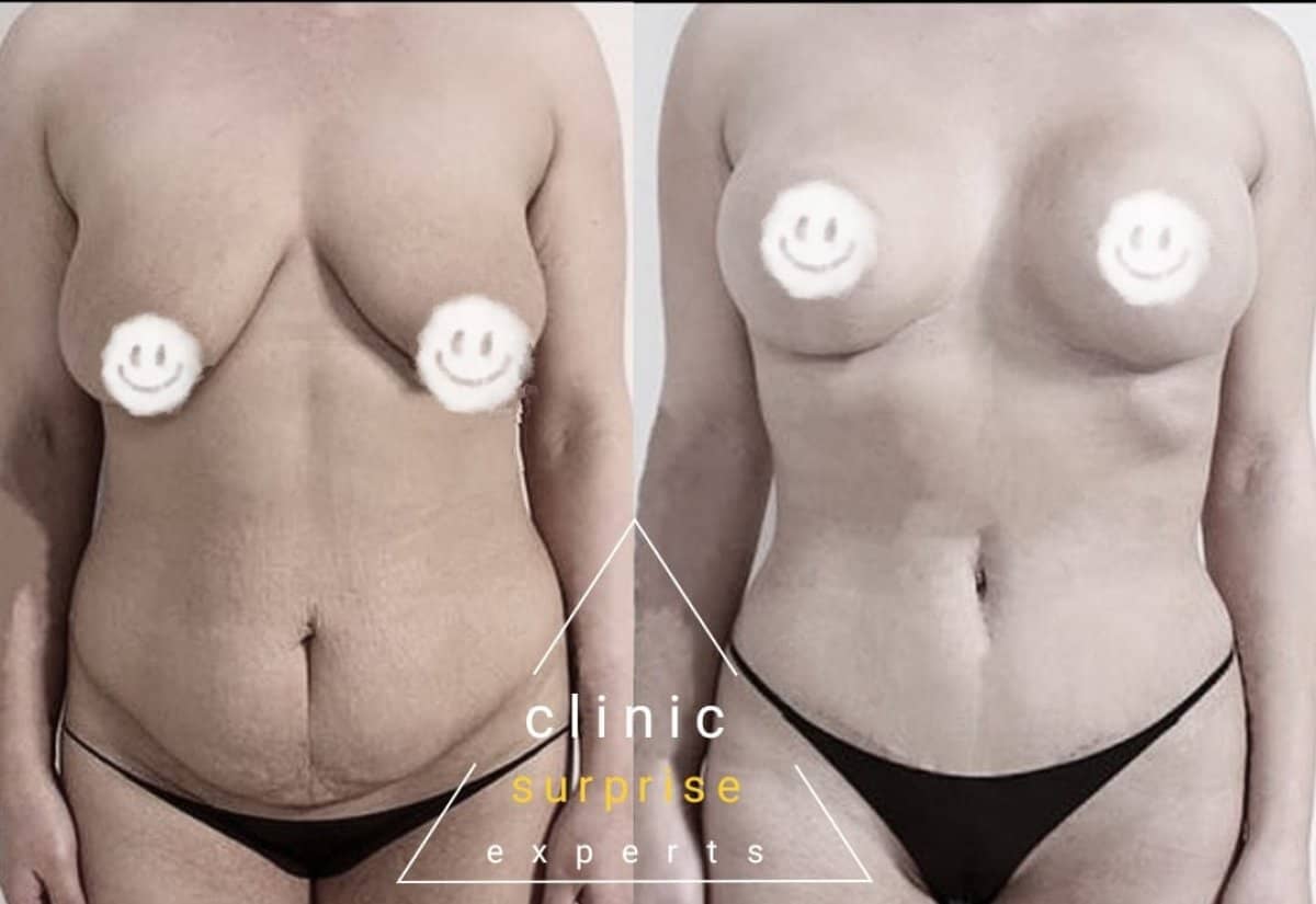 Case 20409 - breast implants with lift