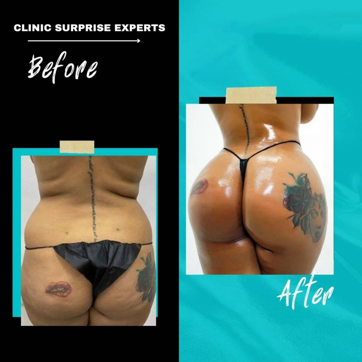Case 20410 - Brazilian Butt Lift