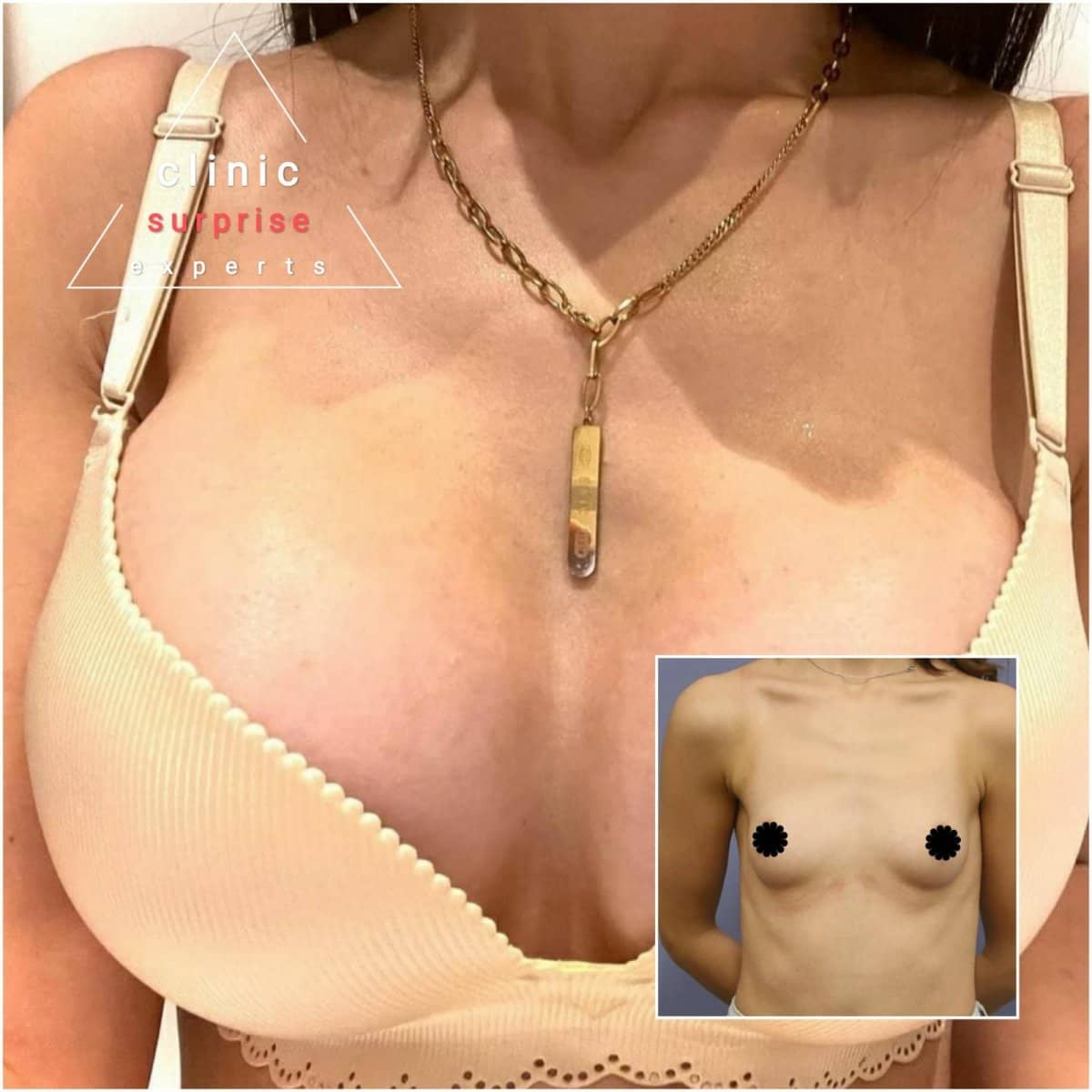 Case 20417 - breast implants with lift