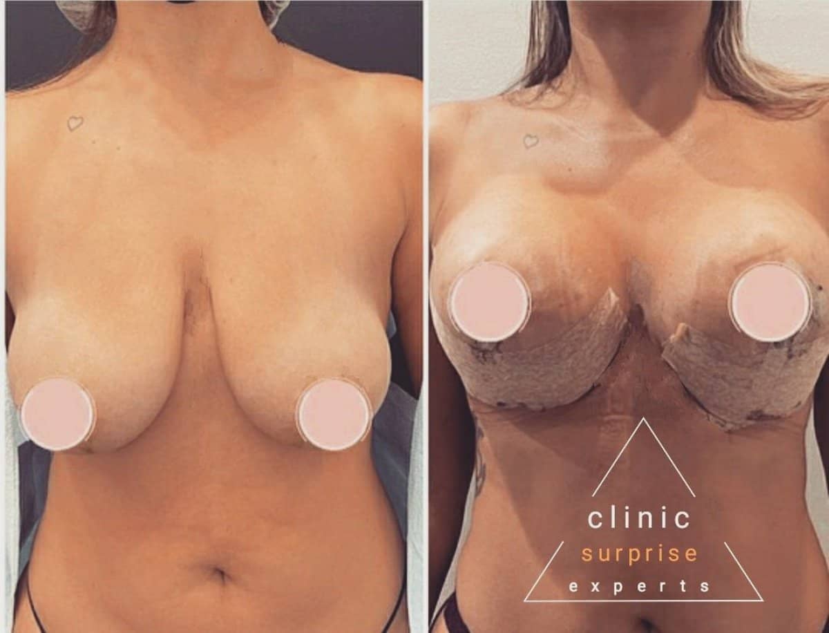 Case 20418 - breast reduction
