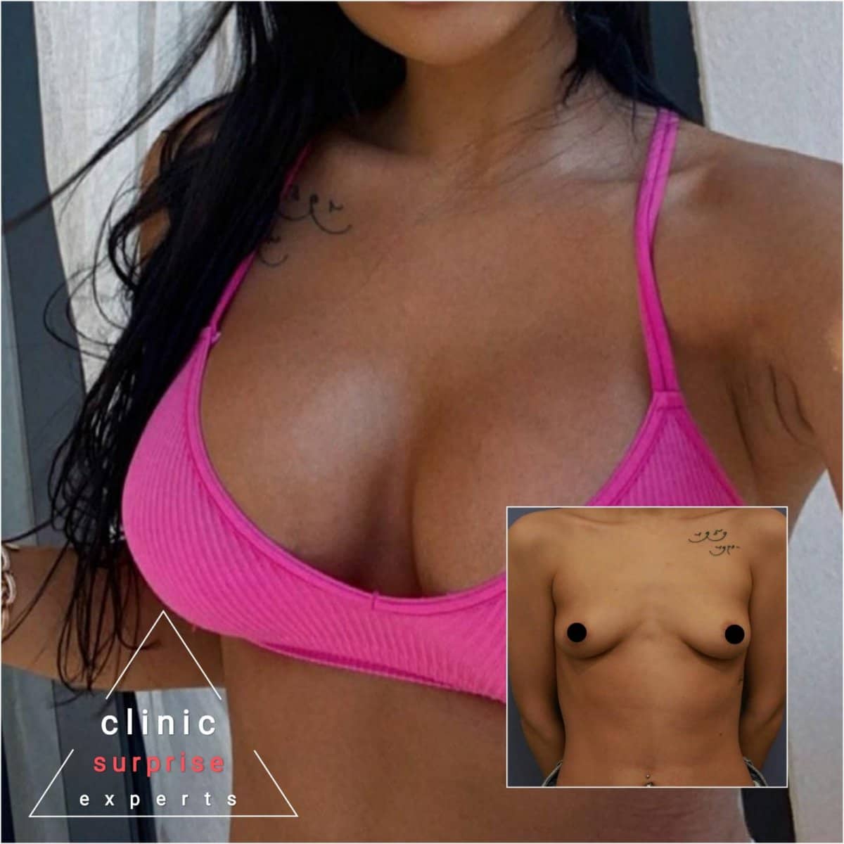 Case 20419 - breast implants with lift