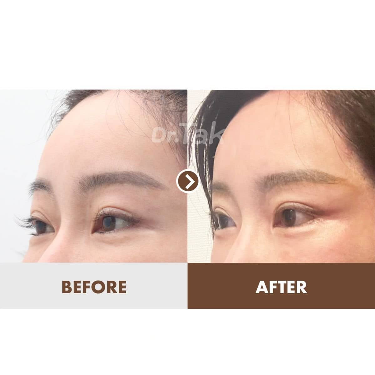 Case 20452 - Fox Eye Lift