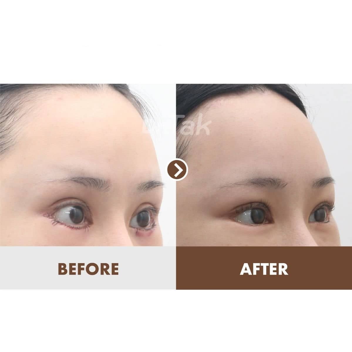 Case 20481 - Fox Eye Lift