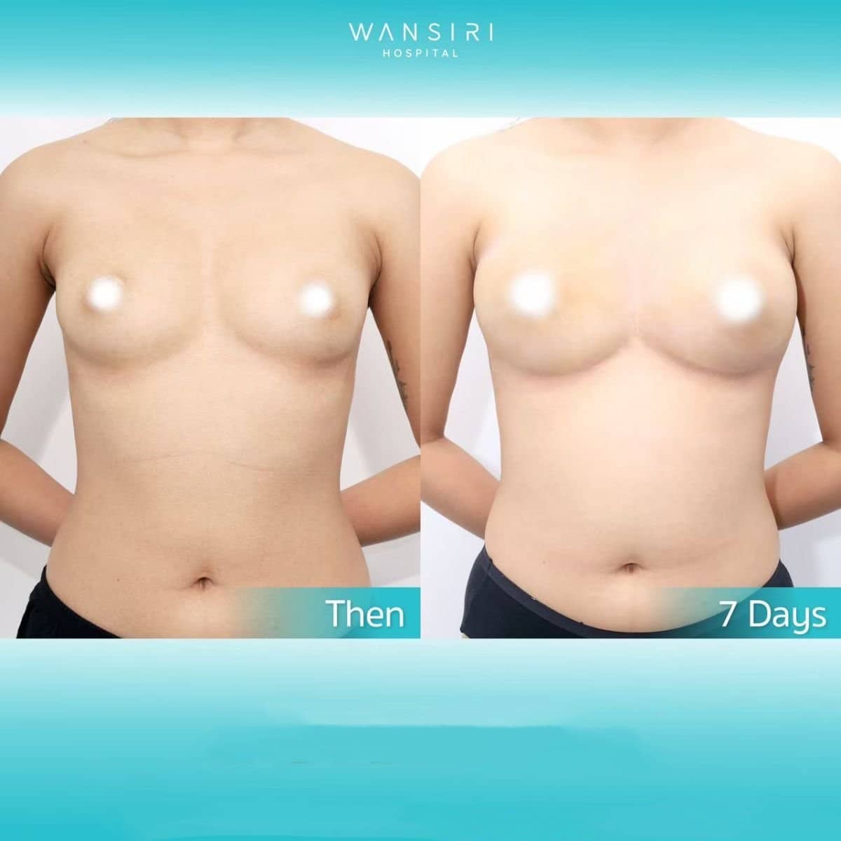 Case 20499 - breast augmentation with fat transfer