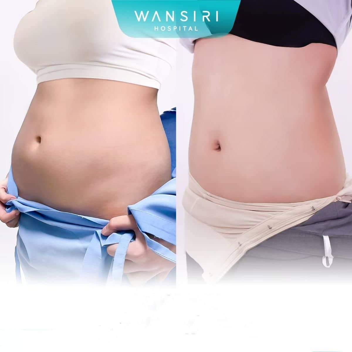Case 20500 - liposuction