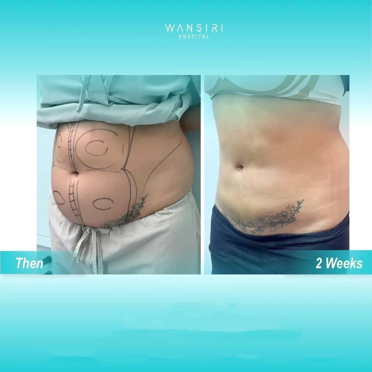 Case 20501 - liposuction