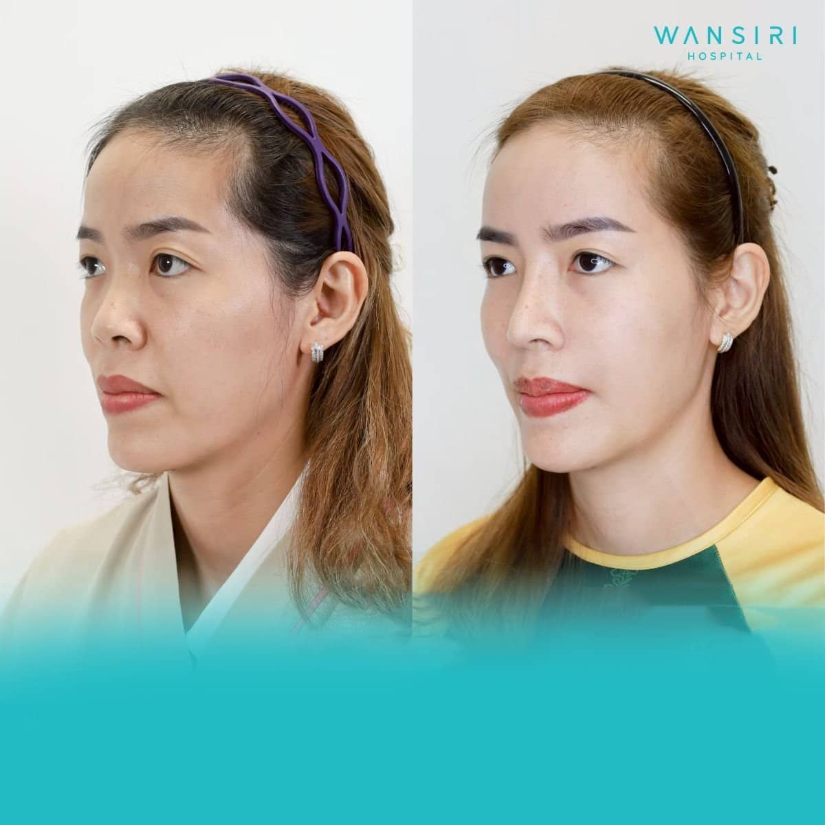Case 20503 - facial fat transfer