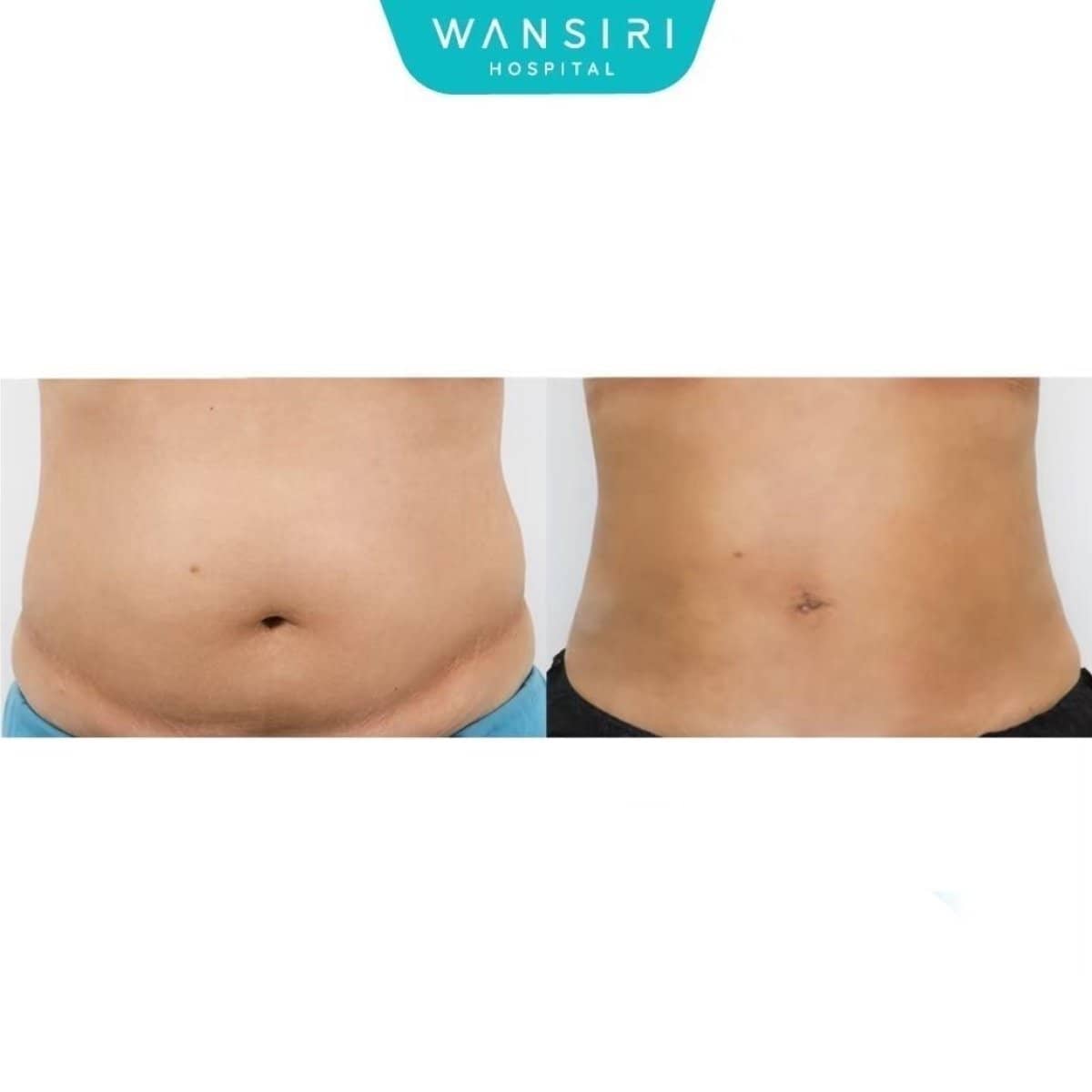 Case 20504 - liposuction