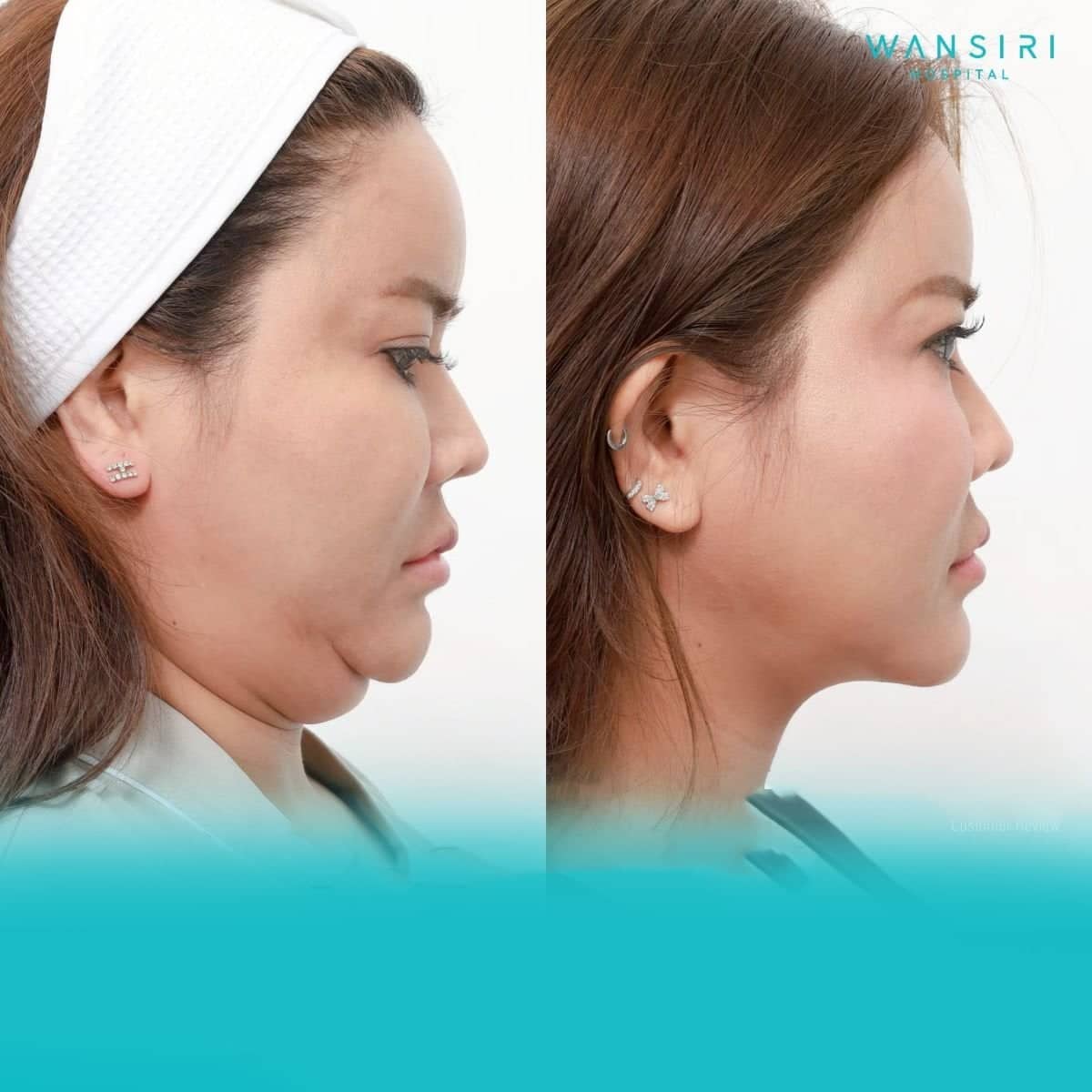 Case 20507 - chin liposuction