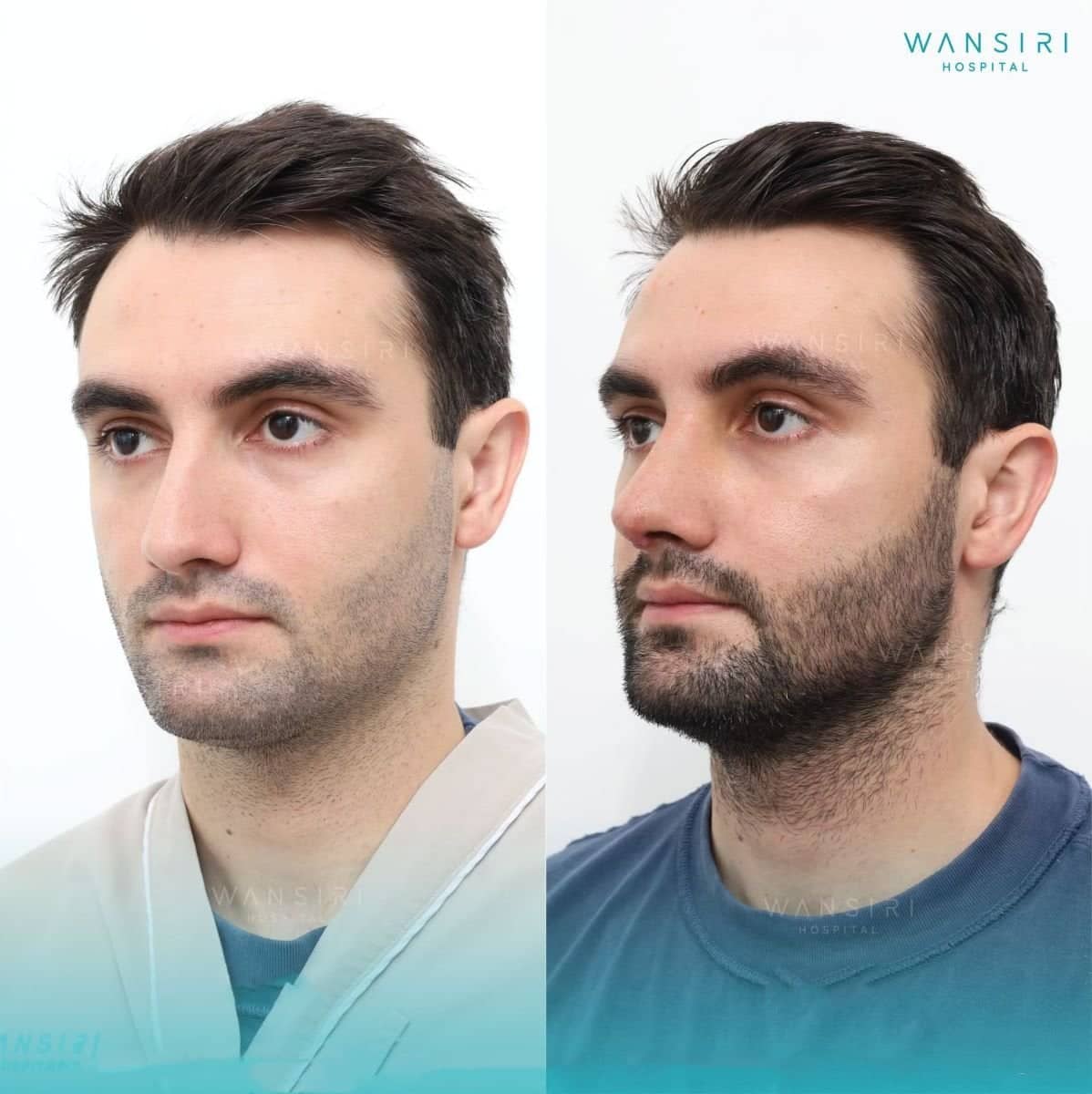 Case 20508 - rhinoplasty
