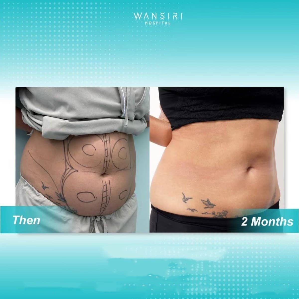Case 20510 - Vaser liposuction