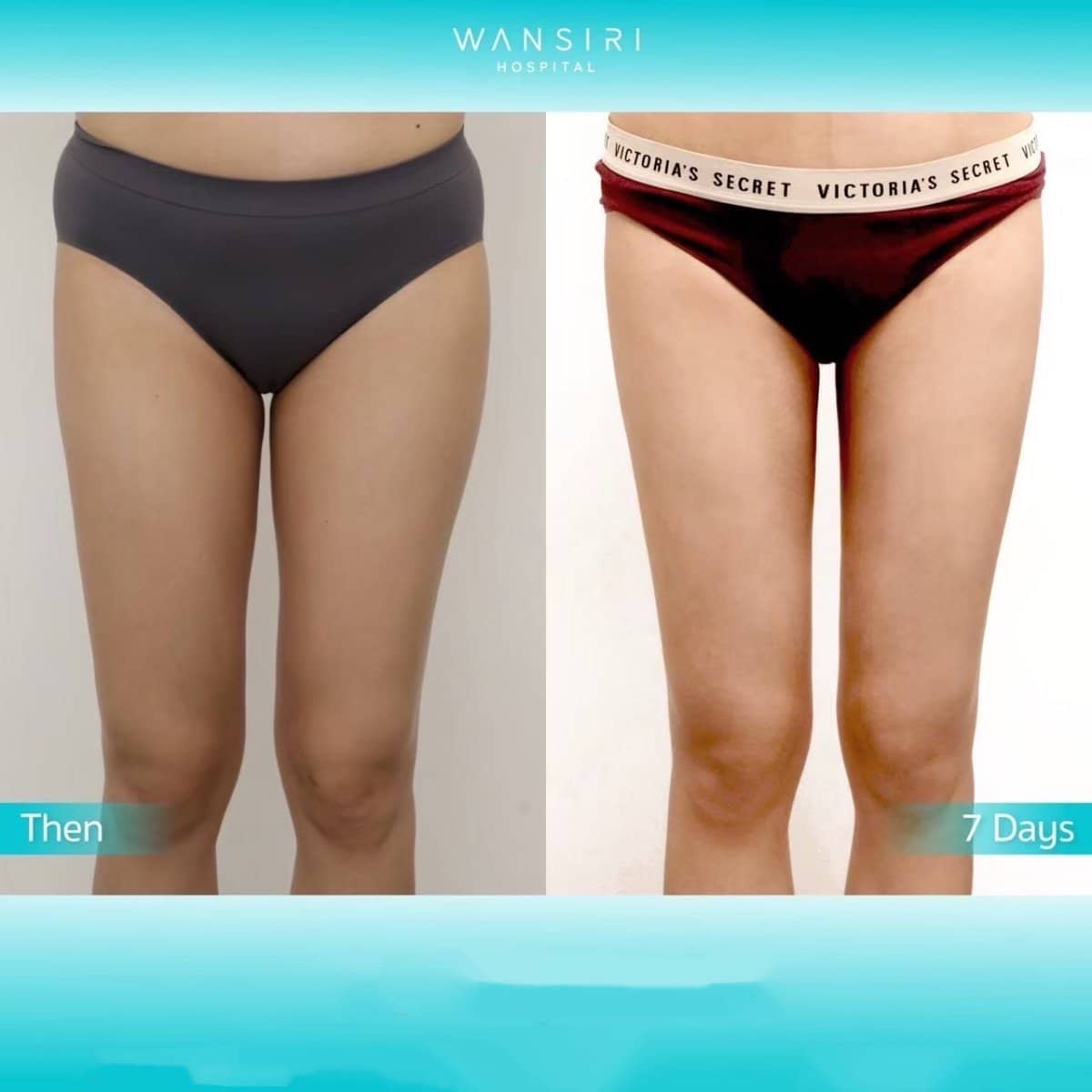 Case 20511 - liposuction