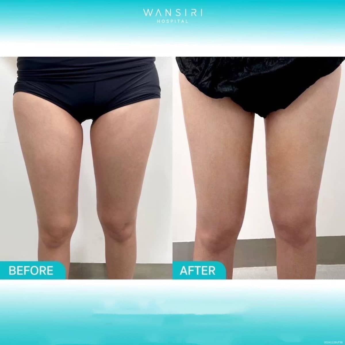 Case 20512 - liposuction