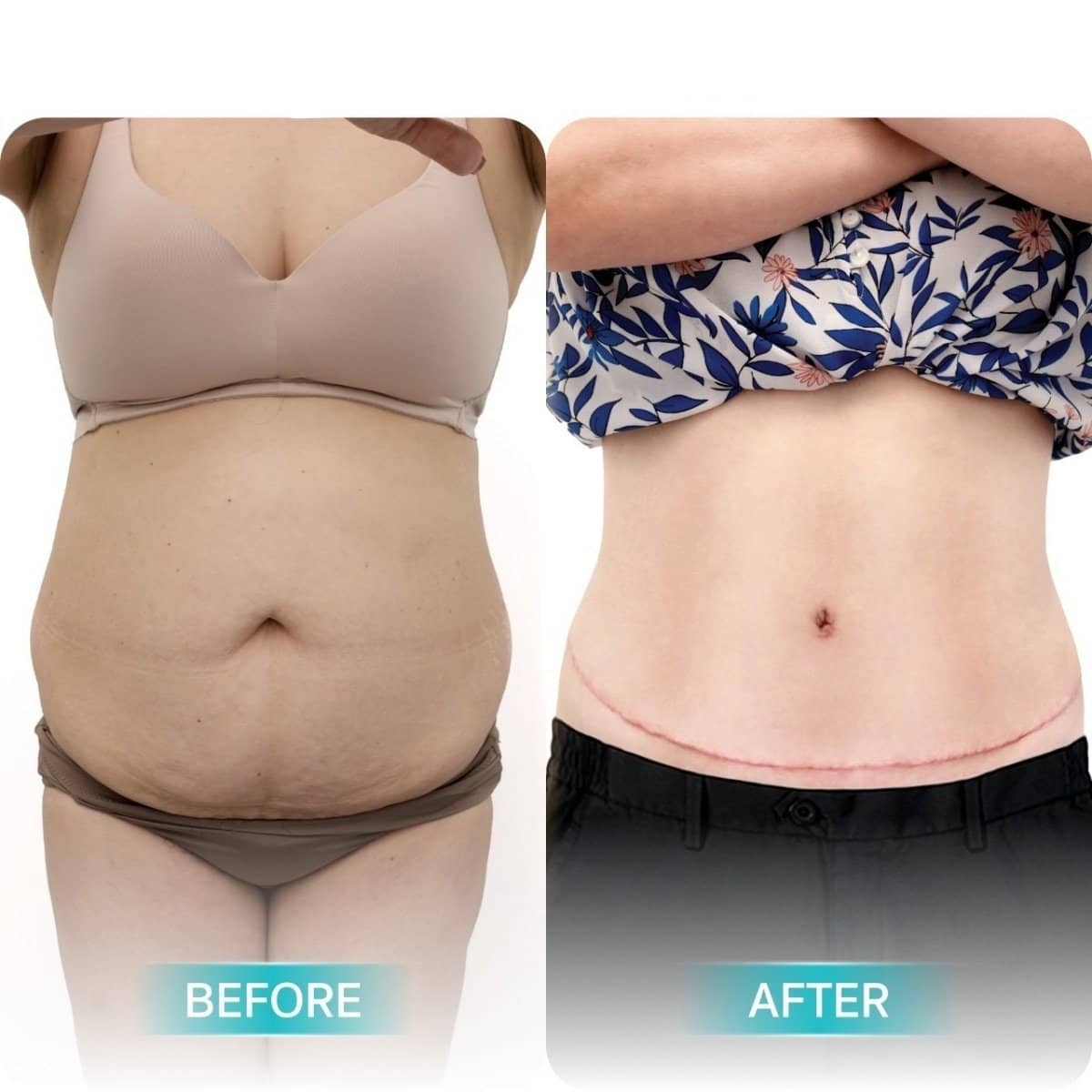 Case 20513 - liposuction