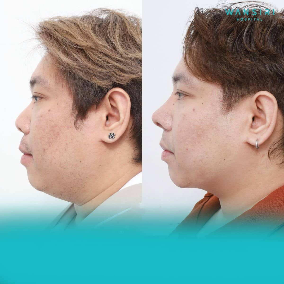 Case 20514 - chin liposuction