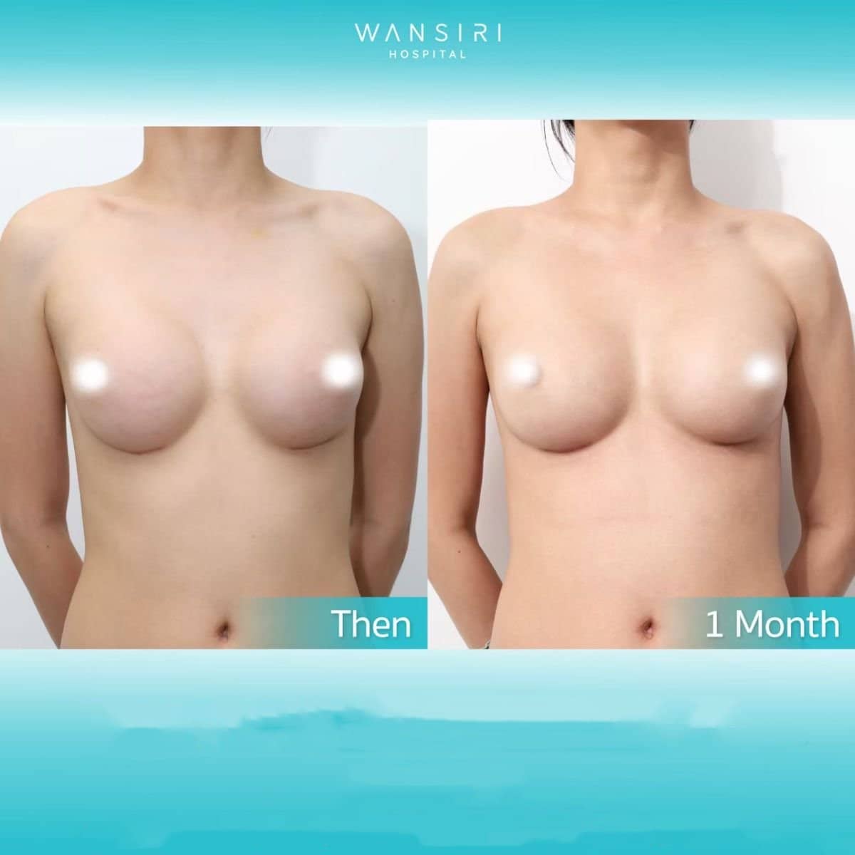 Case 20515 - lipofilling breast augmentation