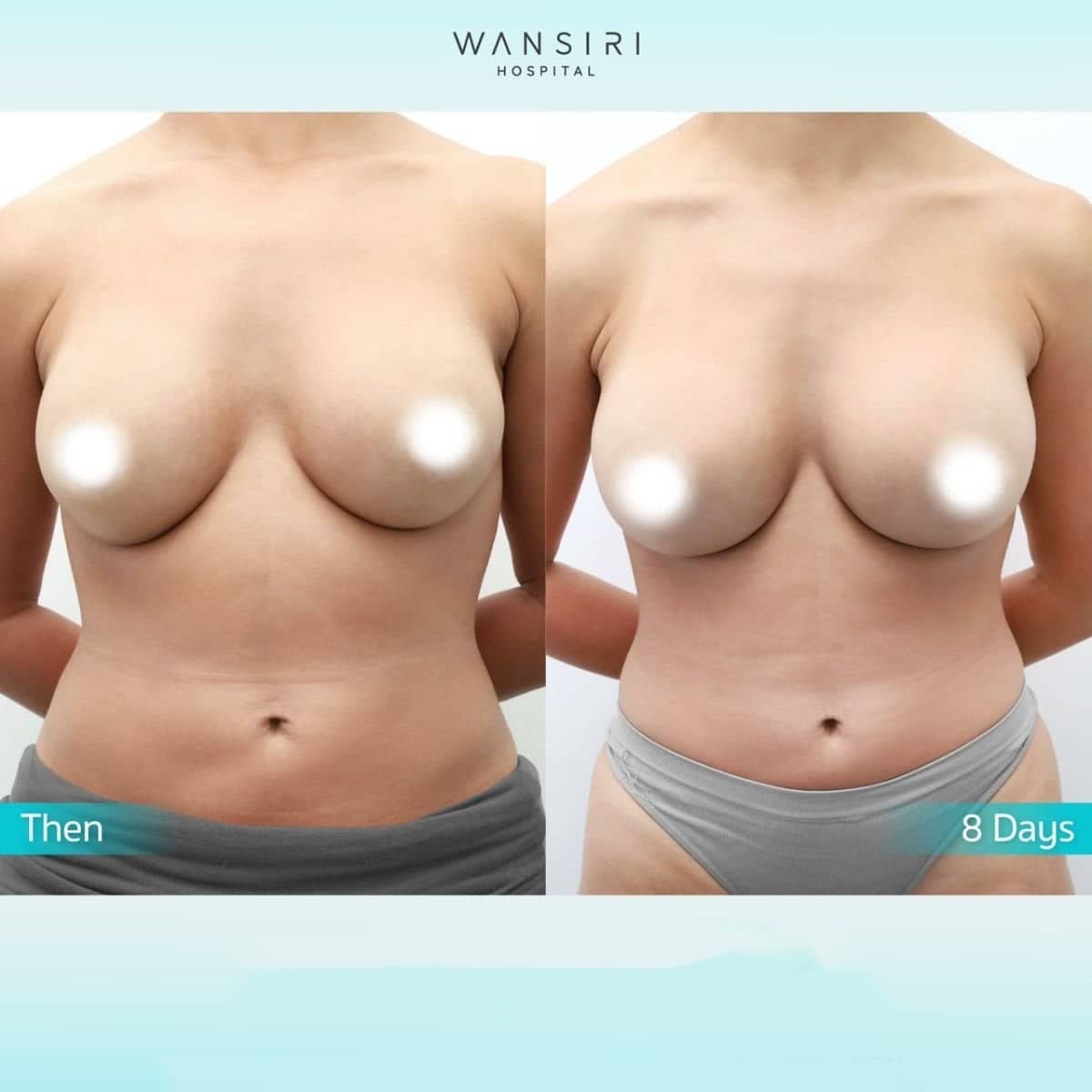 Case 20516 - breast augmentation with fat transfer