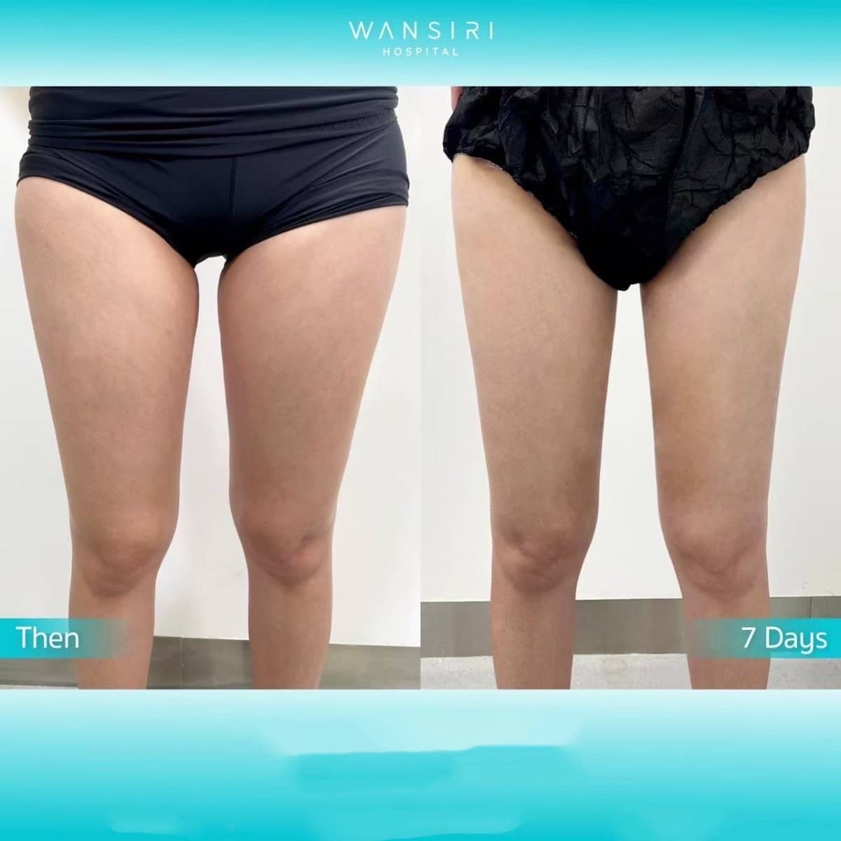 Case 20517 - liposuction