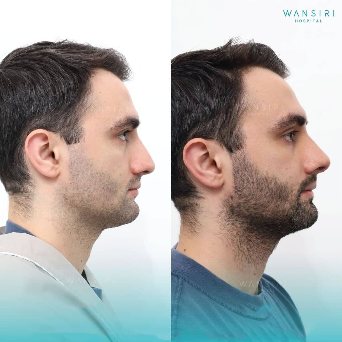 Case 20518 - rhinoplasty