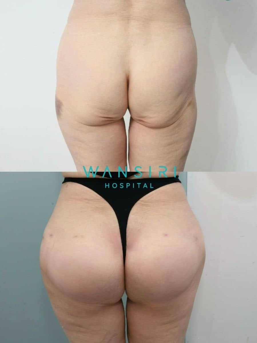 Case 20521 - Brazilian Butt Lift