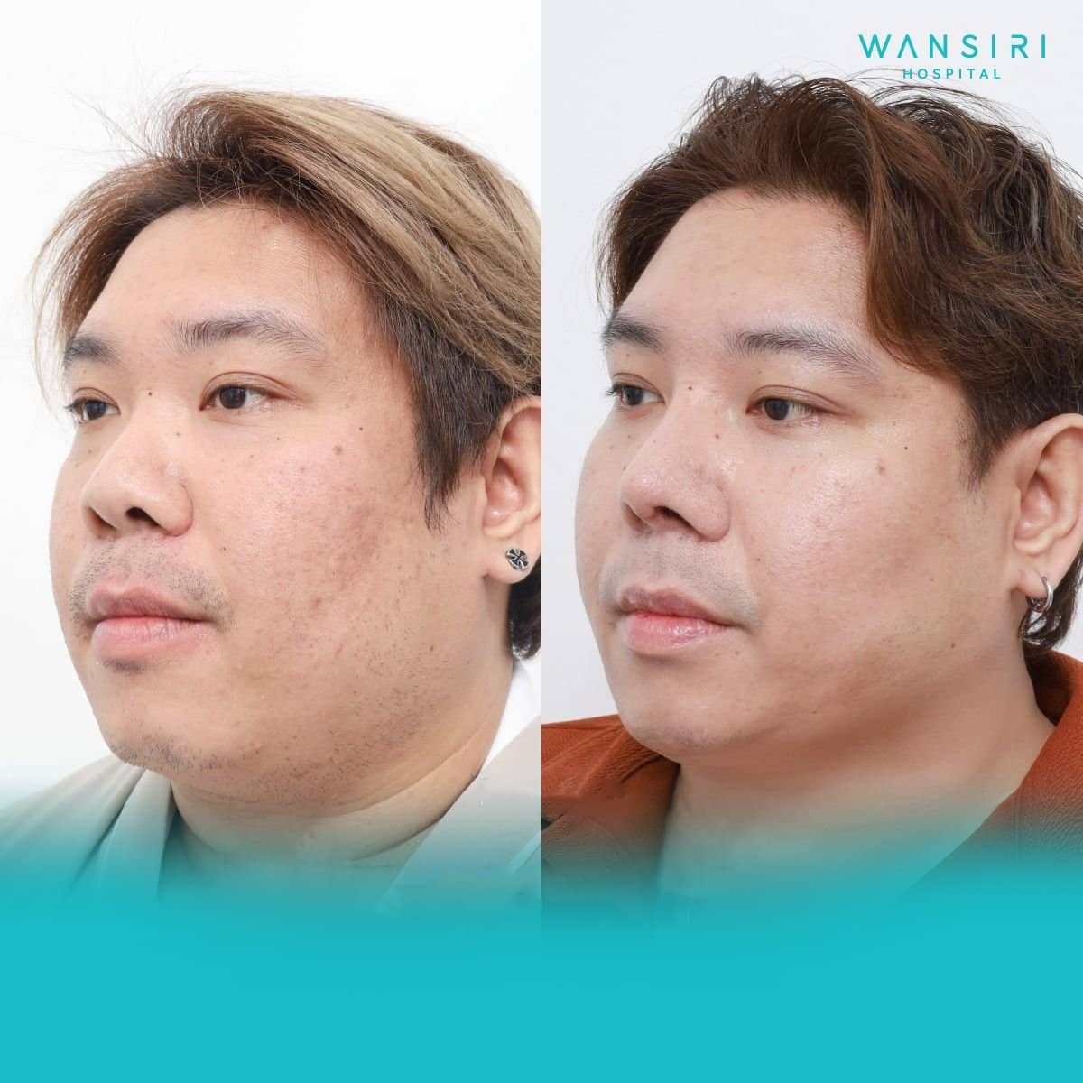 Case 20522 - chin liposuction
