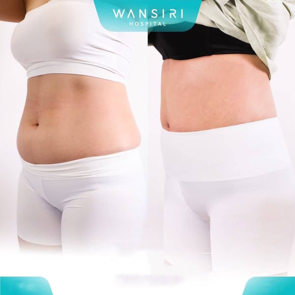 Case 20528 - liposuction