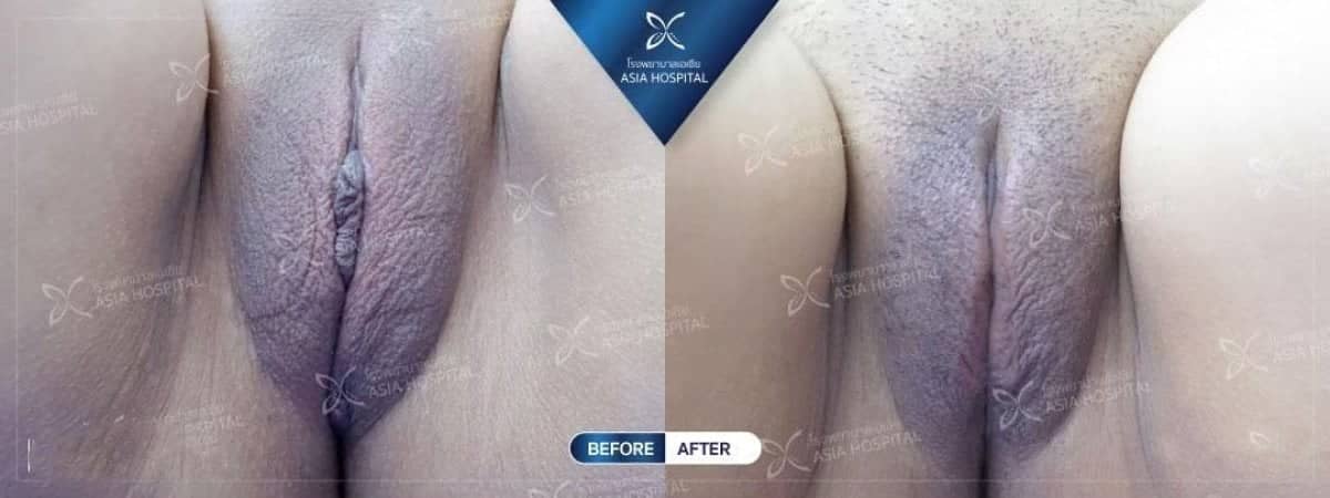 Case 20529 - labiaplasty