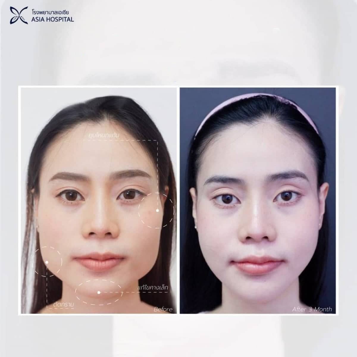 Case 20531 - jaw shaping